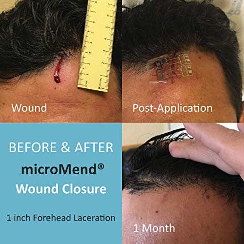 microMend Emergency Wound Closures Surgical Quality Laceration Repair Without Stitches - Think Ahead - Be Prepared- (Kit - 2 microMend Medium Devices, Gauze, Antiseptic Wipe)